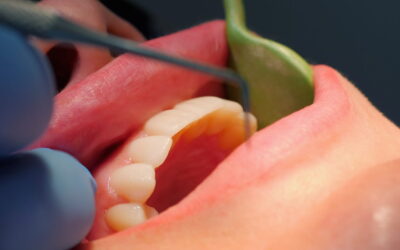 Parodontite e gengive ritirate: cosa fare per proteggere il sorriso